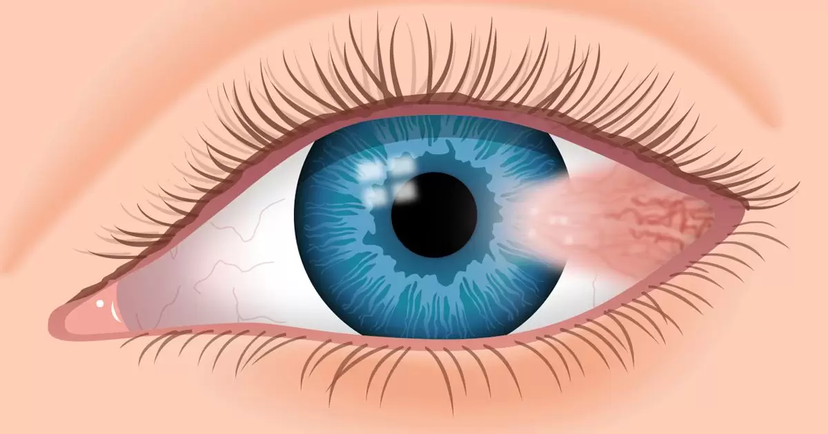 جراحی ناخنک چشم : تشخیص، عوارض و مراقبت ها