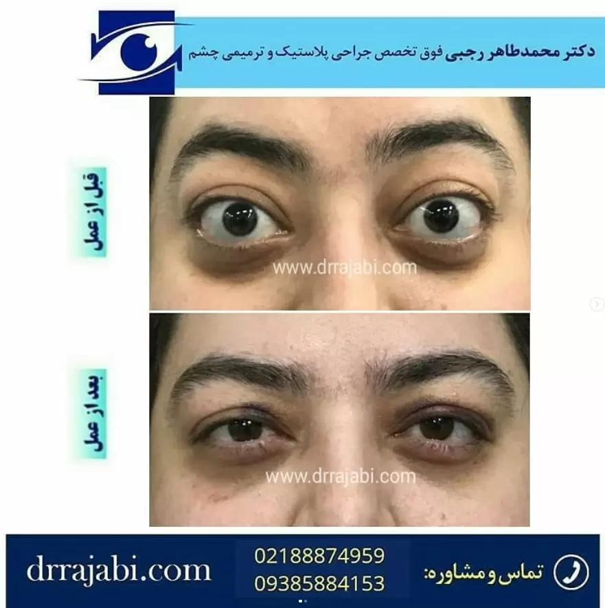 جراحی بیرون زدگی تیروییدی چشم یا تیرویید چشمی یا پروپتوز