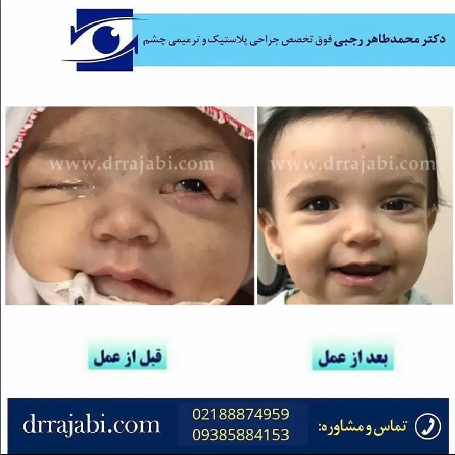 کلوبوم یا شکاف مادرزادی پلک در نوزاد و‌ یکسال پس از جراحی با لبخند زیبای کوچولو