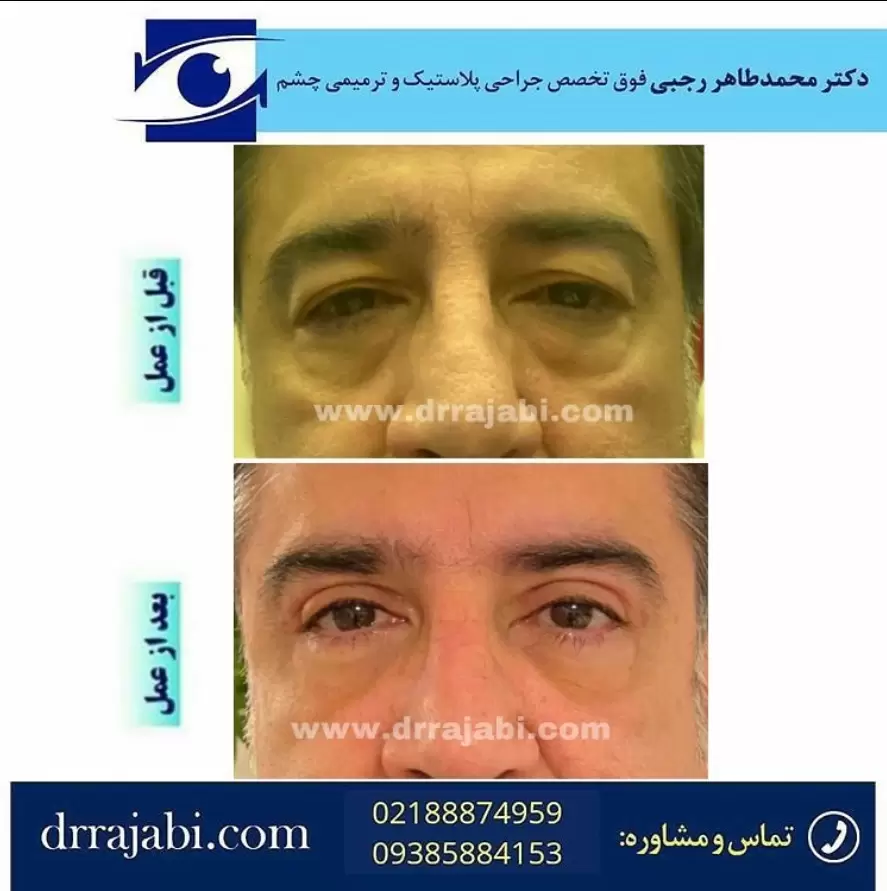 تصاویر قبل و بعد از جراحی پلک بالا و پایین