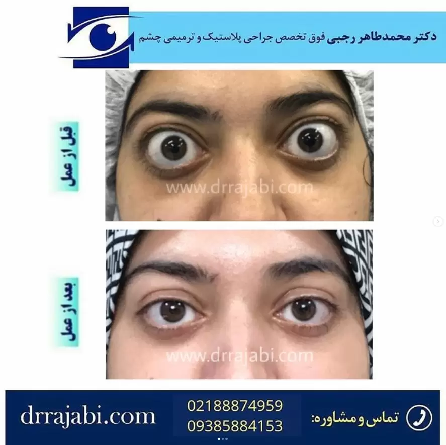 جراحی اصلاح بیرون زدگی یا اگزوفتالمی هر دو چشم در زمینه تیرویید چشمی