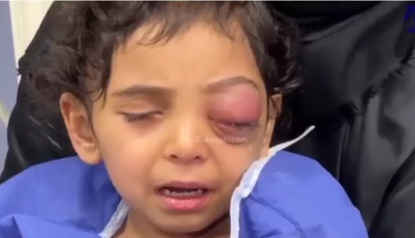 عوارض سینوزیت به دنبال آنفولانزا در کاسه چشم کودک سه ساله