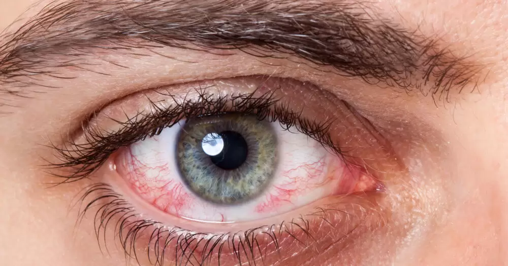 تومورهای چشمی ، علائم و درمان این بیماری