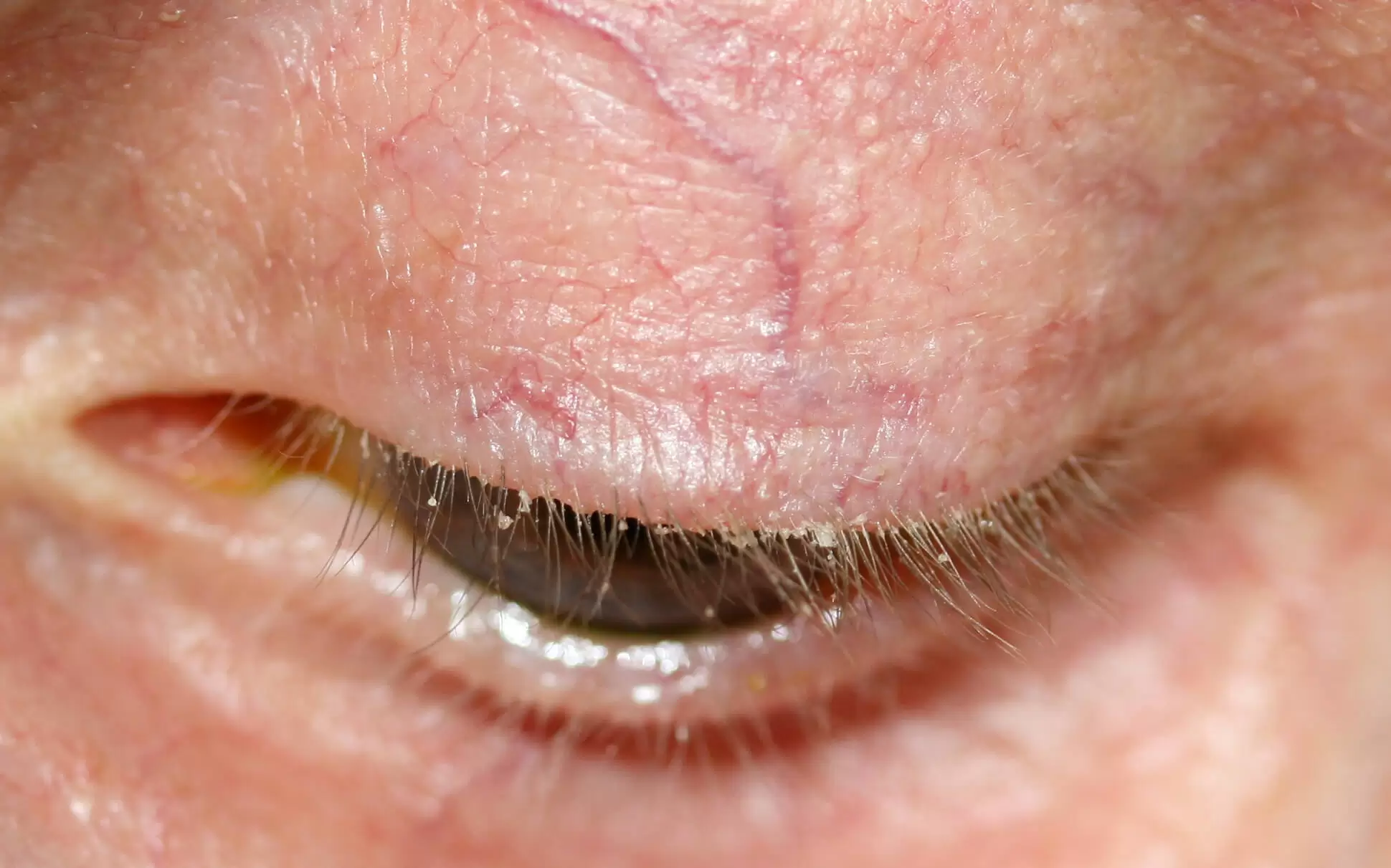 بلفاریت یا التهاب پلک : علائم، علت و درمان