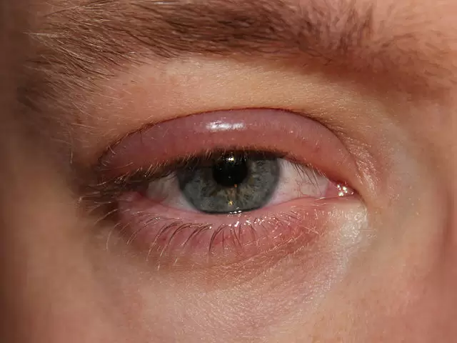 علت التهاب چشم