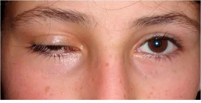 پتوز چشم بعد از بوتاکس چیست و چگونه باید آن را درمان کرد؟