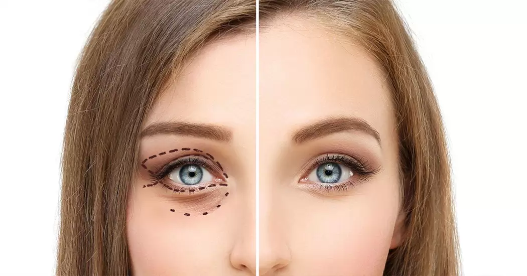 مراقبت‌های بعد از عمل چشم گربه‌ای