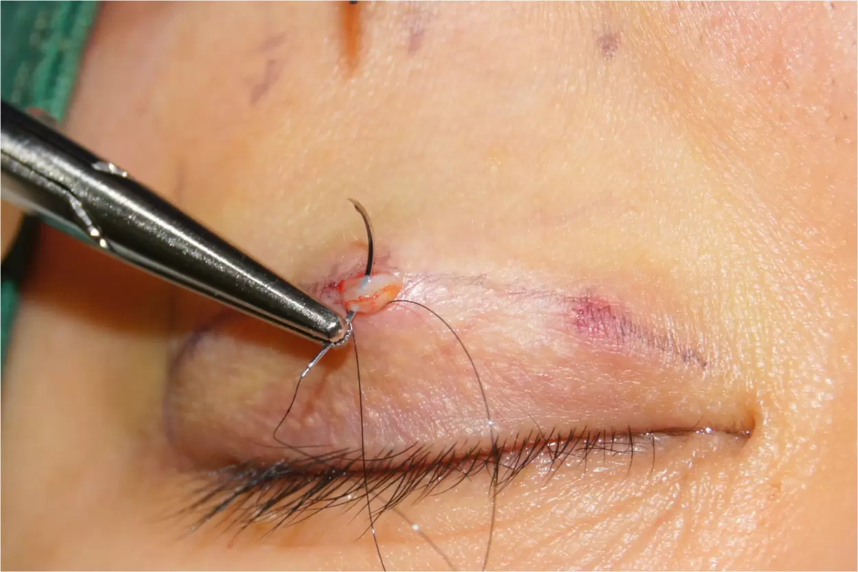 از بین بردن جای بخیه جراحی بلفاروپلاستی